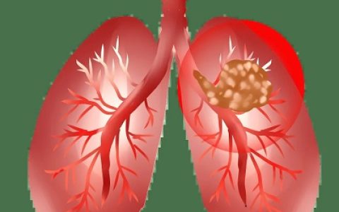 济南炎黄中医：肺结节=肺癌？真相到底是怎样的