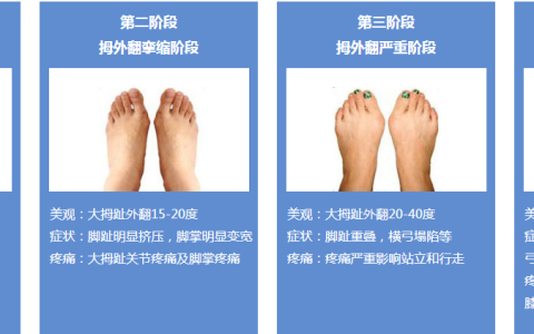 牛江红：什么程度可以做拇外翻手术?——北京丰台广济医院